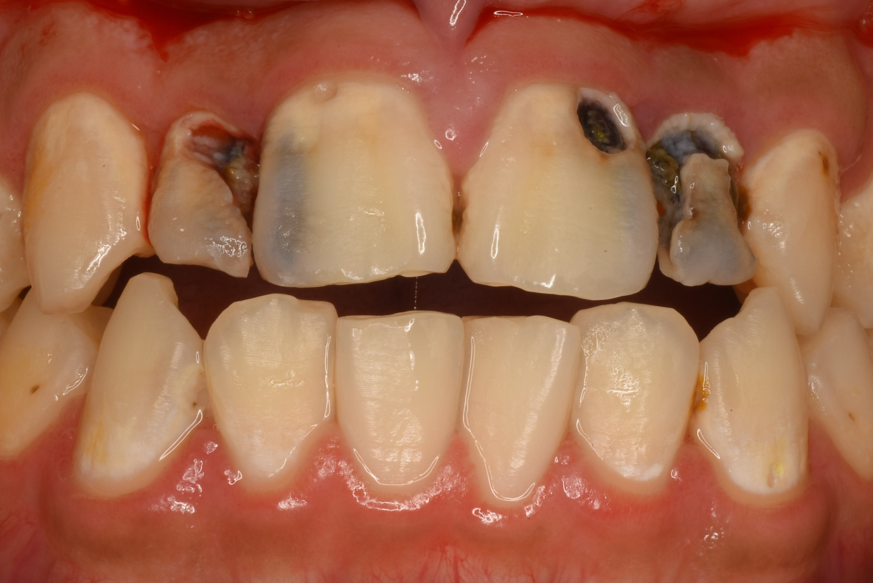 一 番 奥 の 歯 虫歯